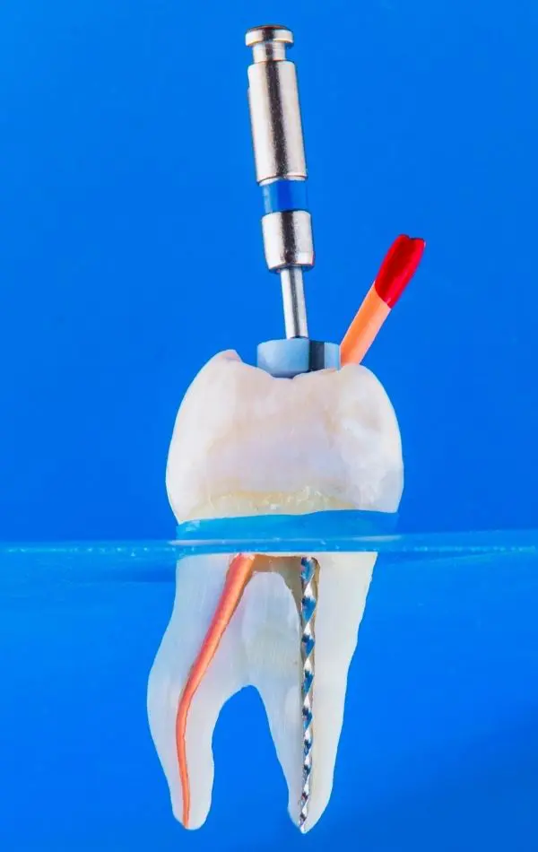 Visual example of a root canal treatment being performed