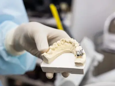 Holding dental prosthesis imprint with metal crown on molar tooth Holding dental prosthesis imprint with metal crown on molar tooth