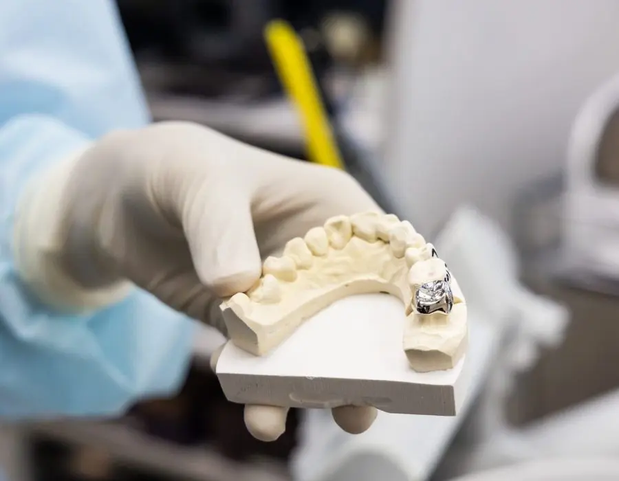 Holding dental prosthesis imprint with metal crown on molar tooth