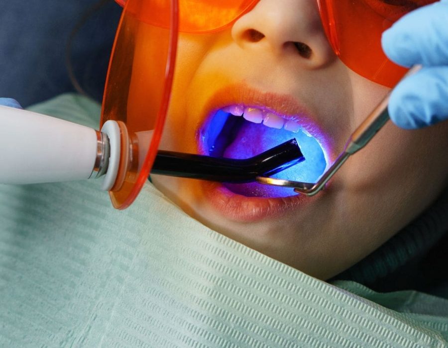 Person getting natural-looking composite fillings at the dentist Person getting natural-looking composite fillings at the dentist