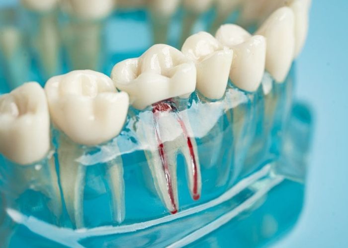 Root Canal visual mold