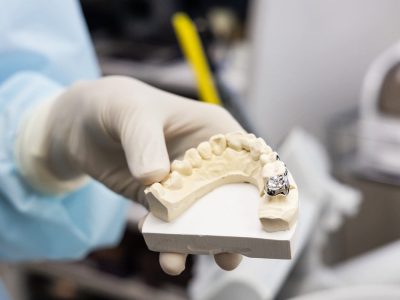 Holding dental prosthesis imprint with metal crown on molar tooth