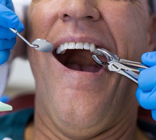 Dentist using surgical pliers to remove a decaying tooth