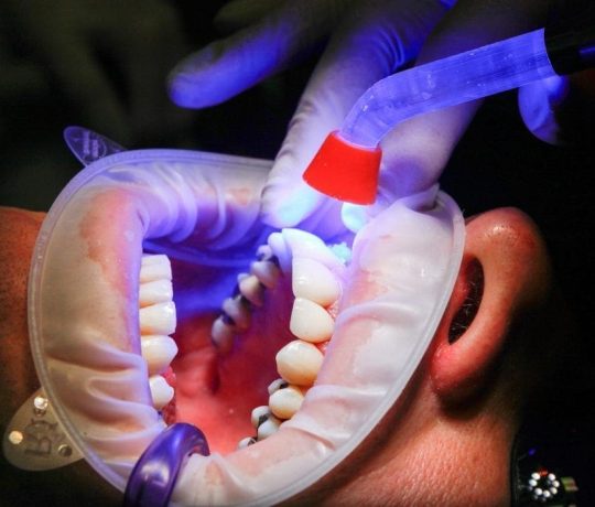 Man at the dentist getting a tooth filling